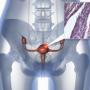 Операция при раке шейки матки: последствия, виды и показания Чем грозит рак шейки матки?